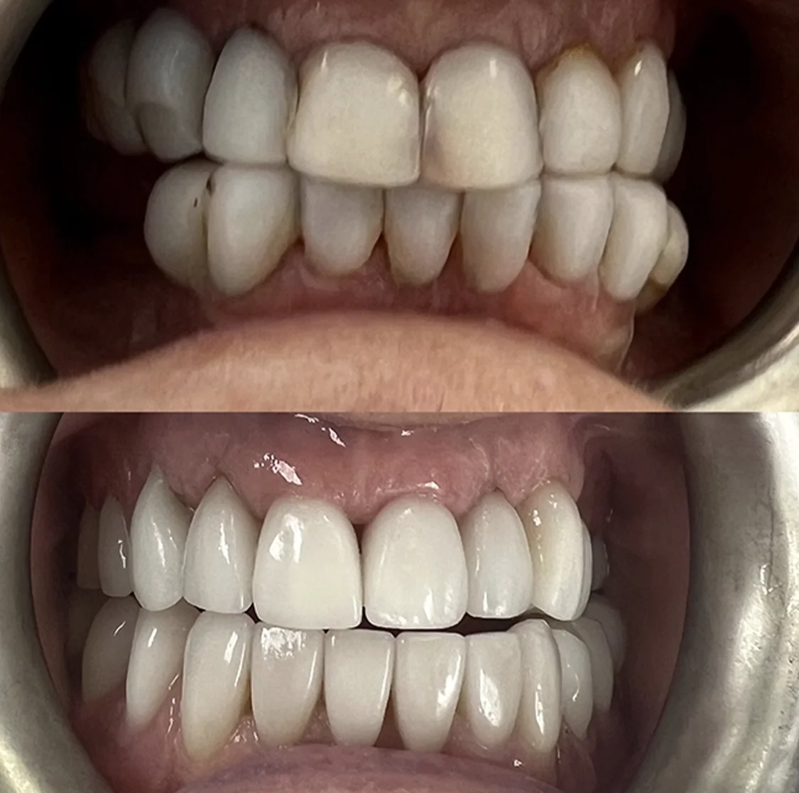 teeth whitening