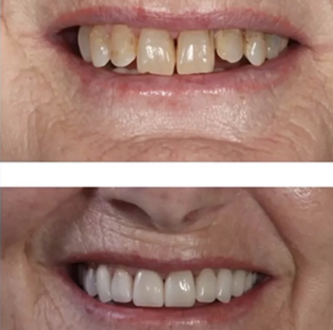 teeth whitening
