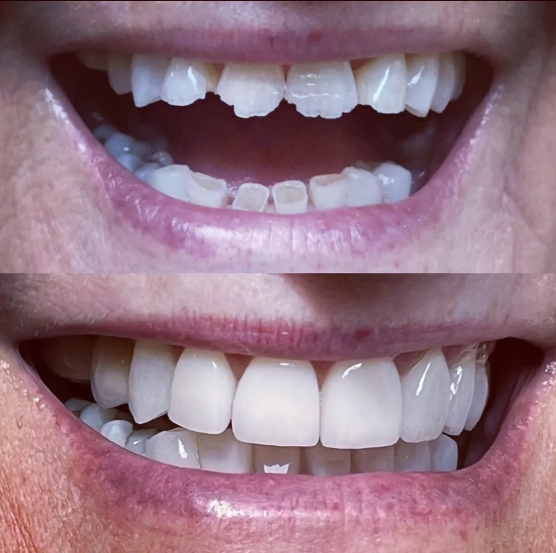 teeth whitening service