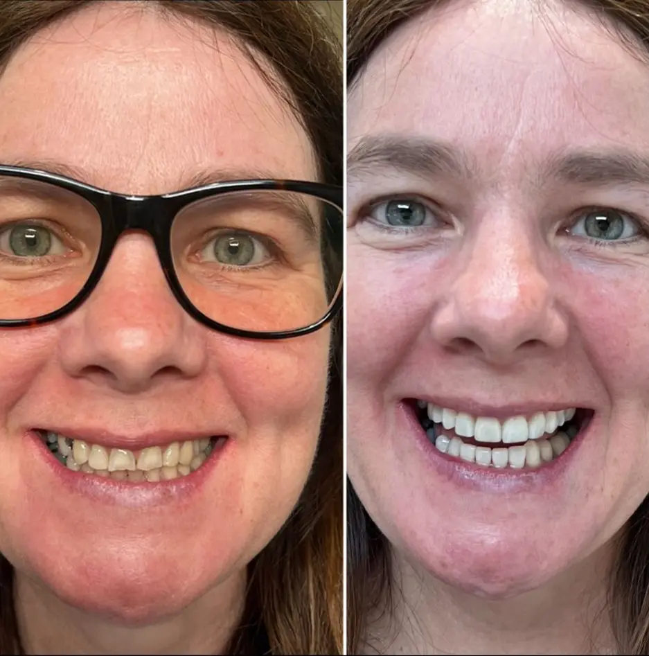 dental implants
