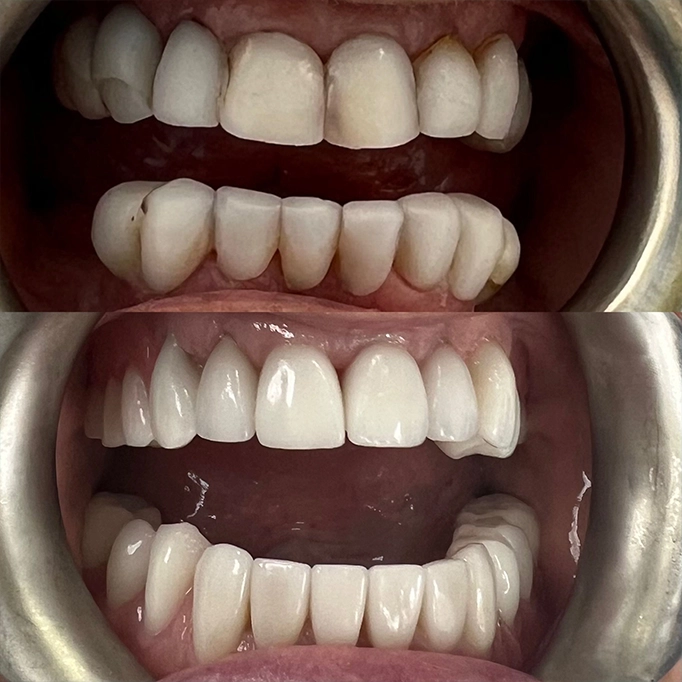 emergency tooth extraction